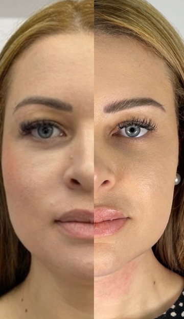 Resultado de harmonização facial natural e sofisticada